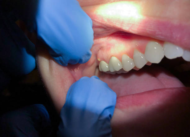 Best Emergency Treatment for Oral Infections in Wells, MN