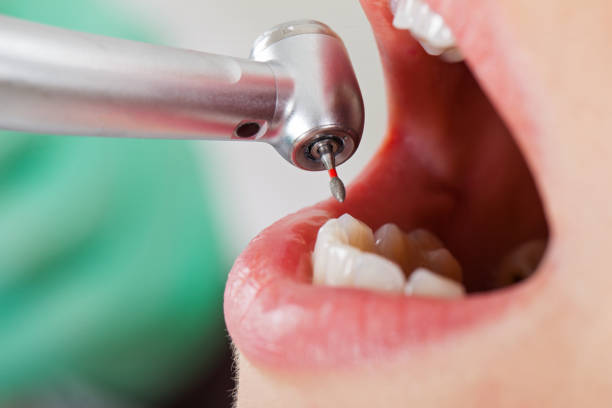 Best Emergency Wisdom Tooth Extraction in Wells, MN
